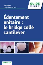 Edentement unitaire le bridge collé cantilever
